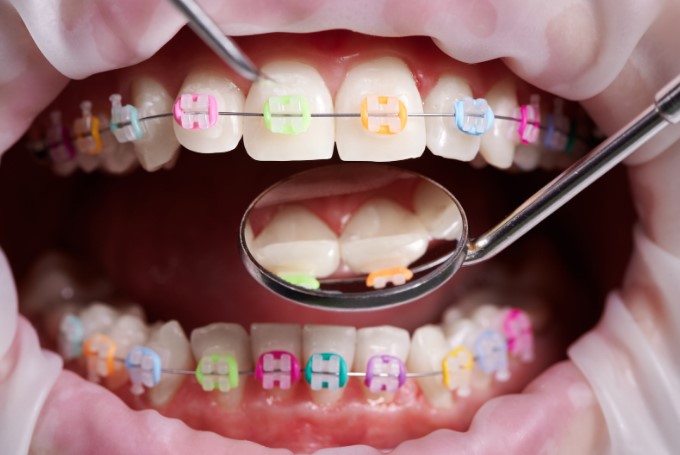 Больно ли устанавливать брекеты? Развенчание мифов и реальные ощущения