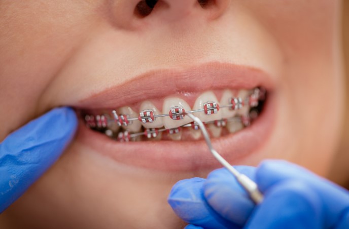 мифы о боли при установке брекетов